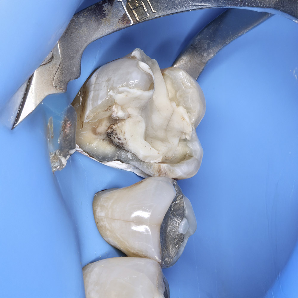Elevación-de-Margen--(DME)-4